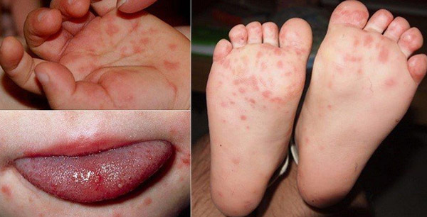 Trẻ bị tay chân miệng đặc trưng với phát ban đỏ dạng phỏng nước trên da 